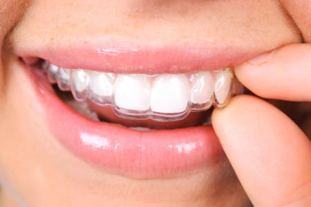 Woman putting in Invisalign aligners