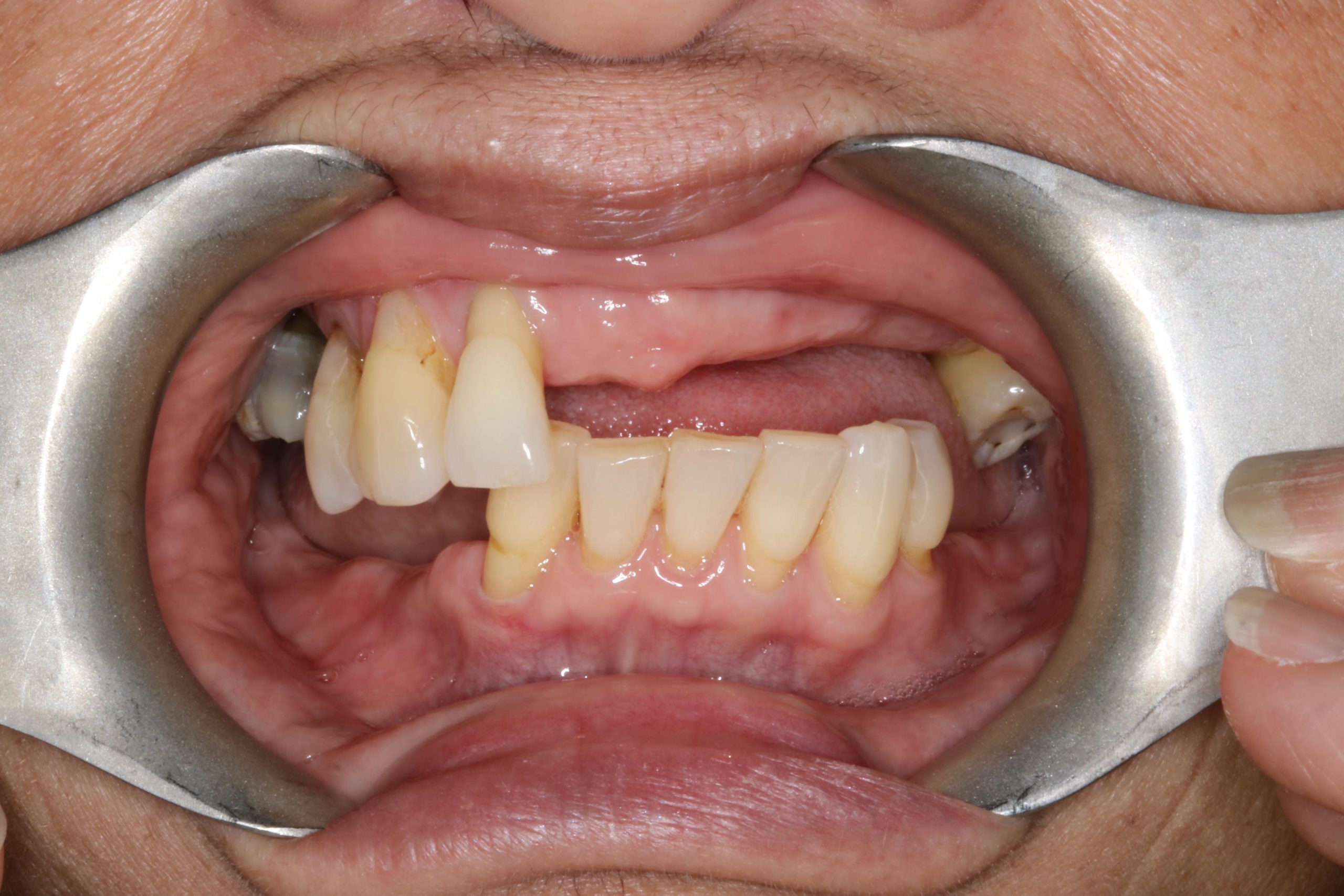 After dental implants