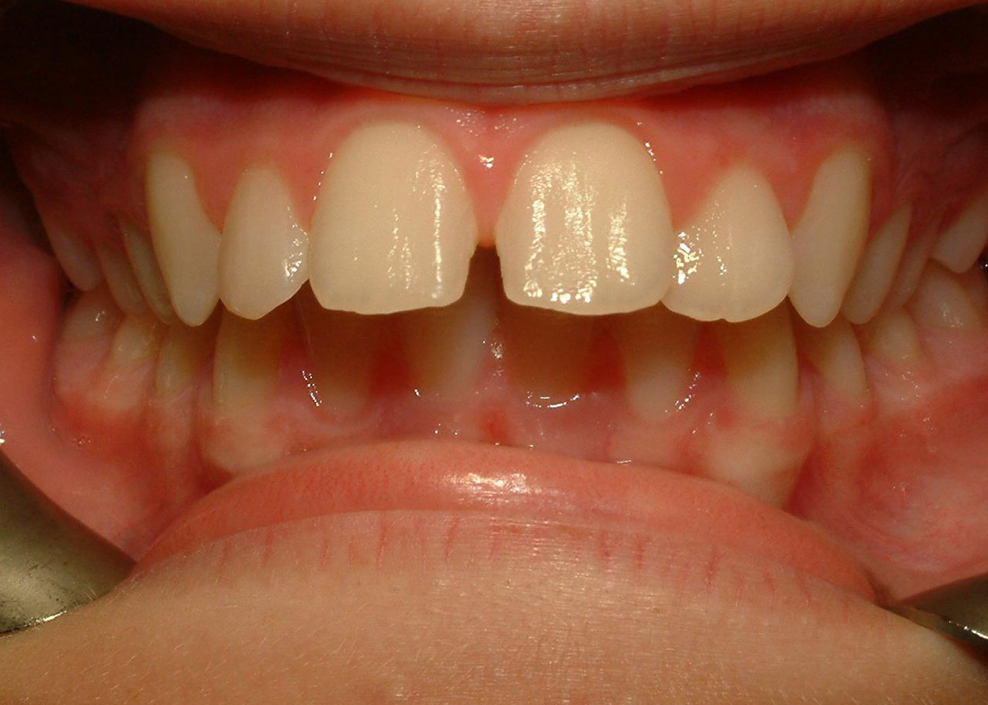 Before orthodontics